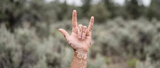 Hand With Vitiligo Signing I Love You